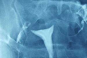 Belirgin Myometrial Foldlar