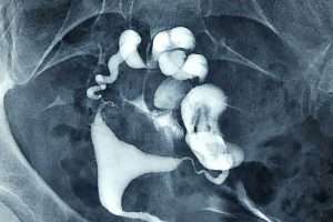 Bilateral Fimbrial Fimozis