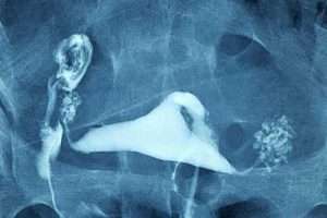 Bilateral Salpenjitis Istmica Nodosa (SIN)