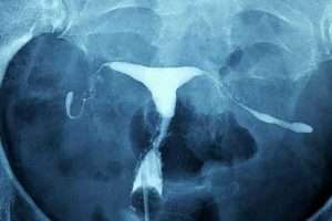 Bilateral Tubal Oklüzyon