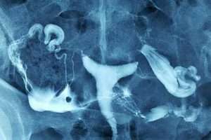 Fimbrial fimozis ve ampuller ektazi