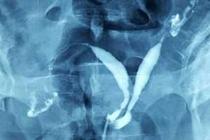 Septate Uterus (Bölmeli Rahim)