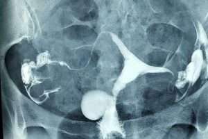 Servikal Kanal Divertikül