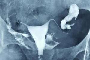 Sol Hidrosalpinks (1)