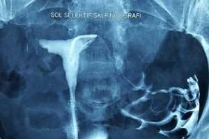 Sol selektif salpingografi