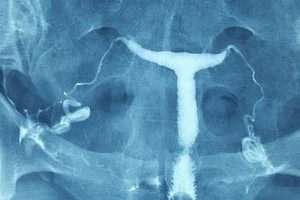 T şeklinde uterus (sineşi)