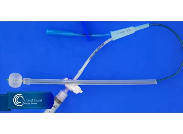 balonlu-hsg-kateteri