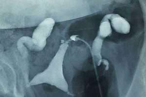 Tüplerde sıvı birikmesi