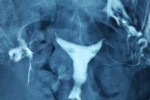 Uterin kavitede polipler