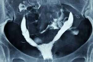 Uterus Bicornis Unicollis